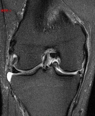 Figure 3 for case bucket-handle tear and ACL tear( RID4725 )( RID2781 )